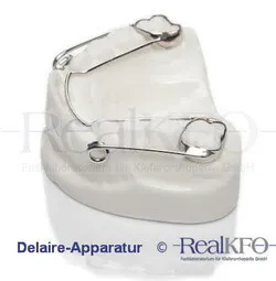 The Delaire Appliance by RealKFO, a fixed orthodontic treatment appliance.