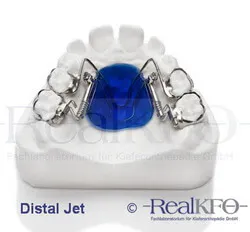 Die Distal Jet Apparatur von RealKFO, eine festsitzende kieferorthopädische Behandlungsapparatur.