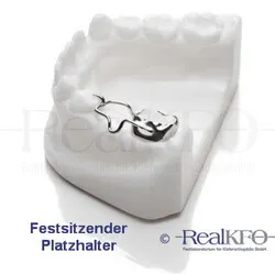 Der festsitzende Platzhalter von RealKFO, eine kooperationsunabhängige Variante einer kieferorthopädischen Apparatur, auf einem Kiefermodell.