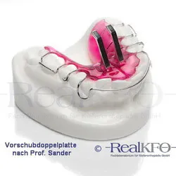 The Feed Double Plate according to Prof Sander by RealKFO, a removable orthodontic treatment appliance.